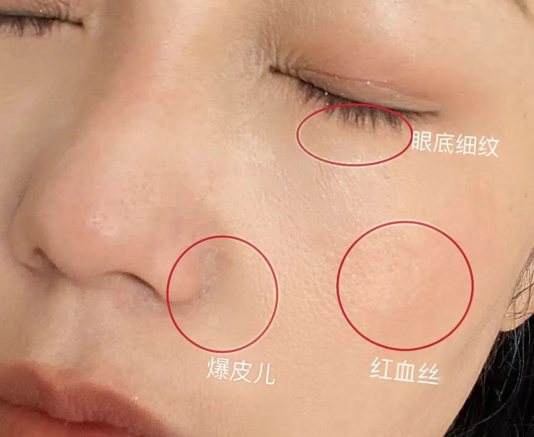 如何判斷自己是不是干敏肌膚？干敏肌有哪些特征？