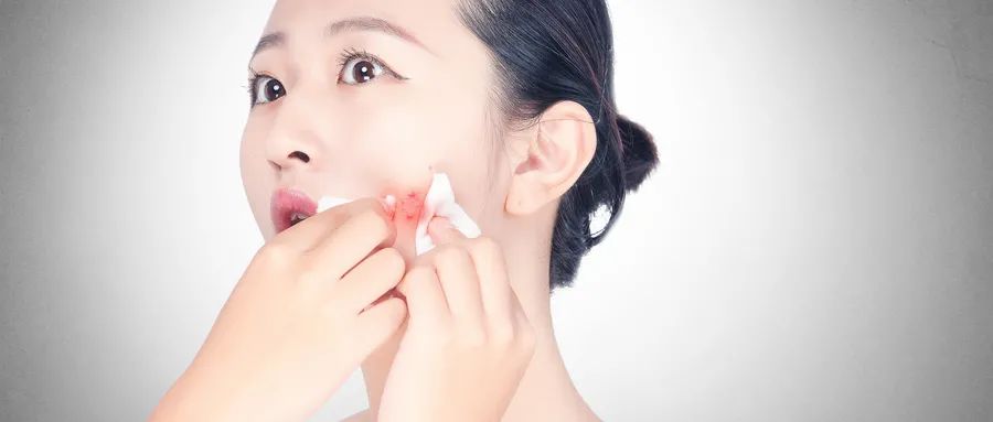 如何預(yù)防粉刺的發(fā)生和痤瘡的形成？