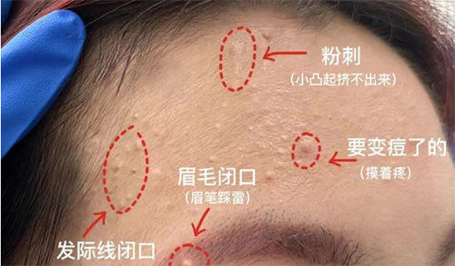 臉上經(jīng)常長(zhǎng)閉口粉刺的原因有哪些？