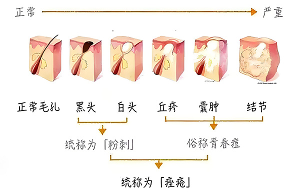 黑頭怎么去除最有效？去除黑頭最有效的方法