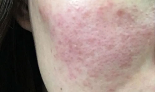 皮膚泛紅癢是什么原因？皮膚紅癢怎么回事？