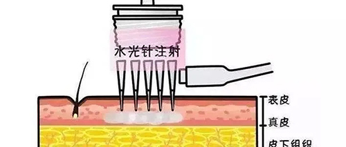 水光針的類型有哪幾種？