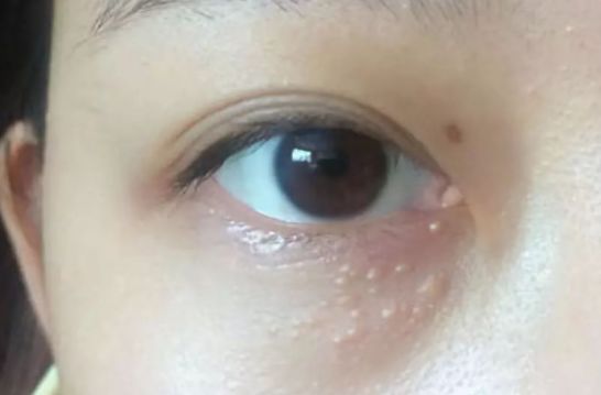 為什么眼部容易長脂肪粒？