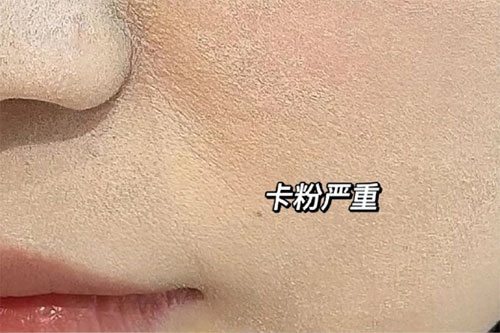卡粉是什么意思？卡粉是什么原因引起的？