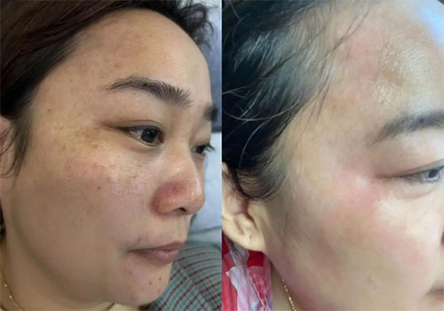 祛斑最好的土方法有哪些？