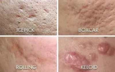 如何祛除痘坑？祛除痘坑最好的方法