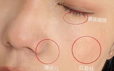 如何判斷自己是不是干敏肌膚？干敏肌有哪些特征？