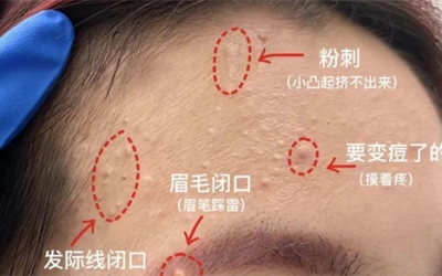 臉上經(jīng)常長閉口粉刺的原因有哪些？