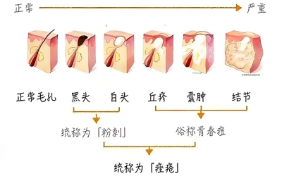 黑頭怎么去除最有效？去除黑頭最有效的方法