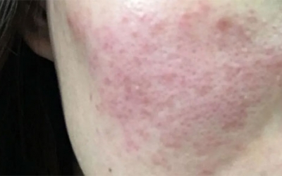 皮膚泛紅癢是什么原因？皮膚紅癢怎么回事？